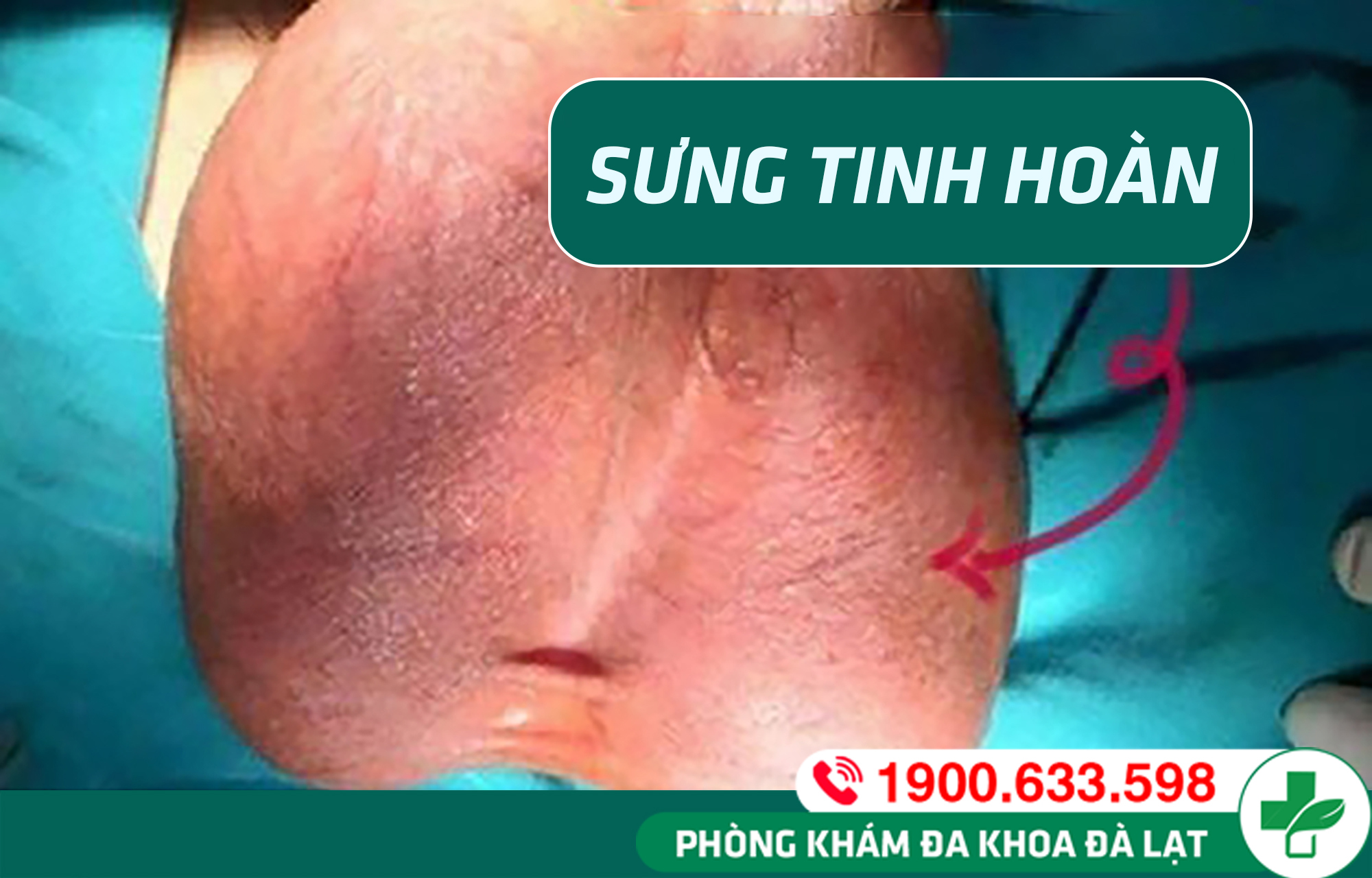 SƯNG TINH HOÀN, SƯNG 1 BÊN, BỊ ĐAU, KHÔNG ĐAU VÀ NHỮNG ĐIỀU CẦN BIẾT
